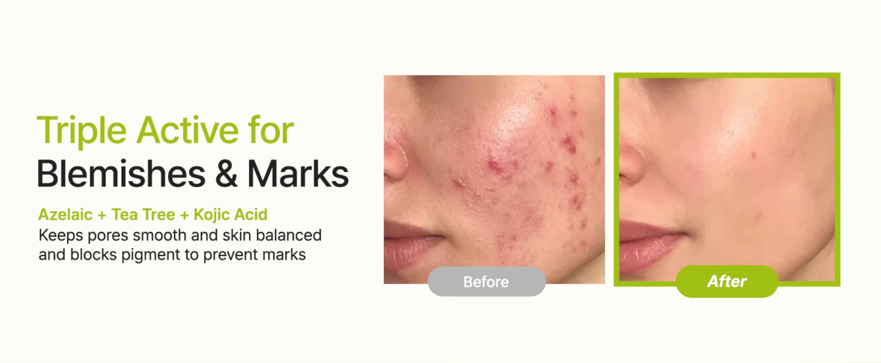Purito-Azelaic-Acid-10-Kojic-Tea-Tree-Serum